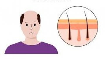Understanding Androgenetic Alopecia (Male Pattern Baldness)